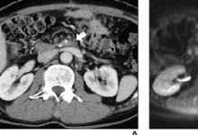 DWI 检测局部复发性胰腺癌