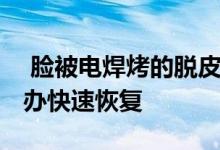  脸被电焊烤的脱皮怎么快速恢复 脸脱皮怎么办快速恢复 