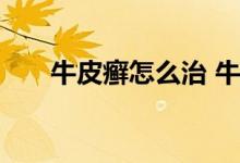 牛皮癣怎么治 牛皮癣的各种治疗方法 