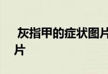  灰指甲的症状图片 5种灰指甲的初期症状图片 