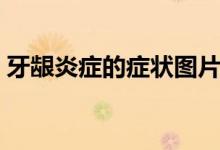 牙龈炎症的症状图片（牙龈炎症状（图文））