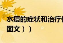 水痘的症状和治疗偏方（水痘的症状和治疗（图文））